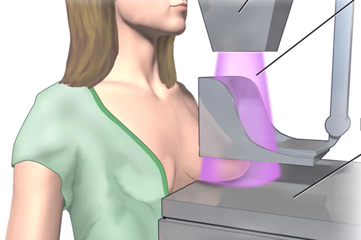 , What Does It Mean to Have Dense Breast Tissue?
