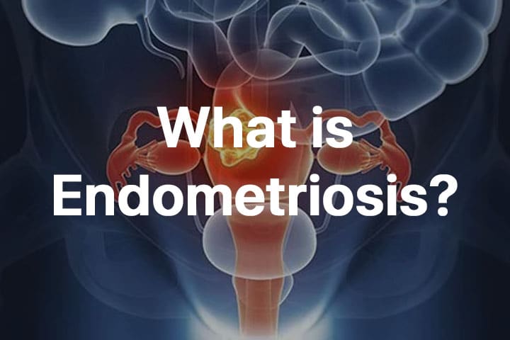 Endometriosis, What is Endometriosis? Symptoms, Causes &#038; Treatment
