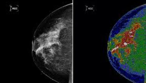 , What Does a Mammogram Show?