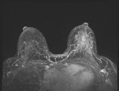 breast MRI, The Benefits of Breast MRI for High-Risk Patients