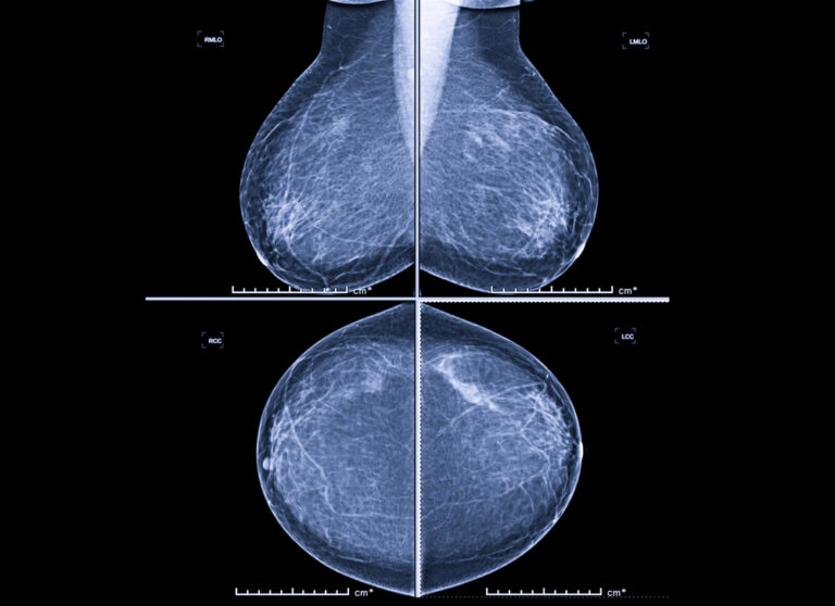X-ray Digital Mammogram both side CC view and MLO . mammography or breast scan for Breast cancer